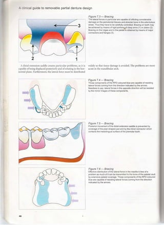 Maxillary Lateral Rpd A clinical guide_to_removable_partial_denture_design | PDF