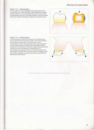 Reciprocal Tooth A clinical guide_to_removable_partial_denture_design | PDF