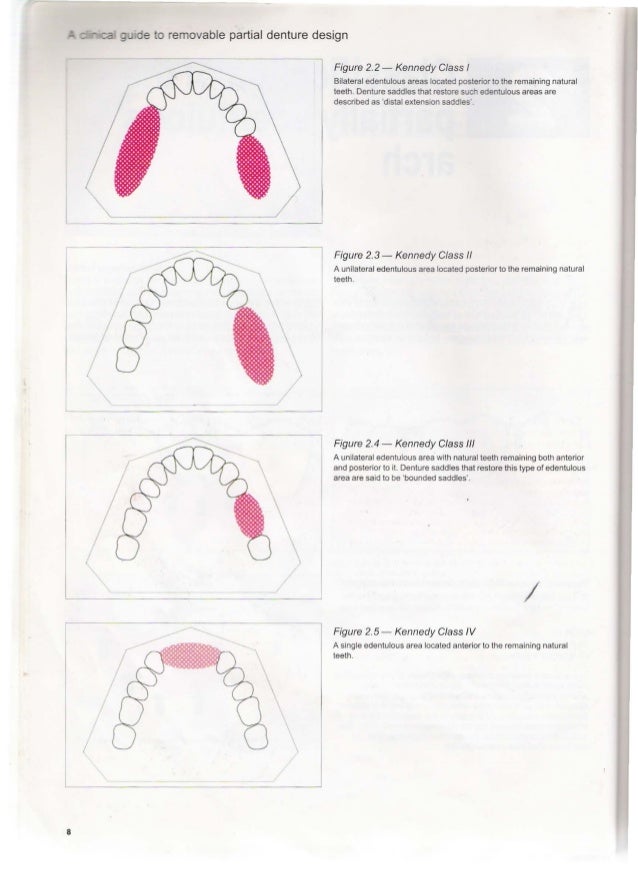 A clinical guide_to_removable_partial_denture_design