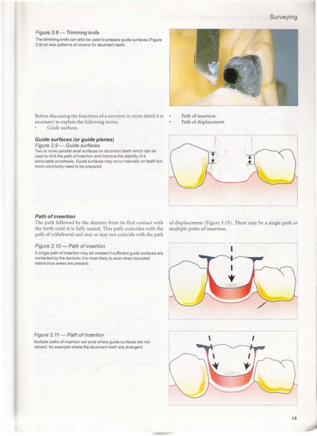 A clinical guide_to_removable_partial_denture_design