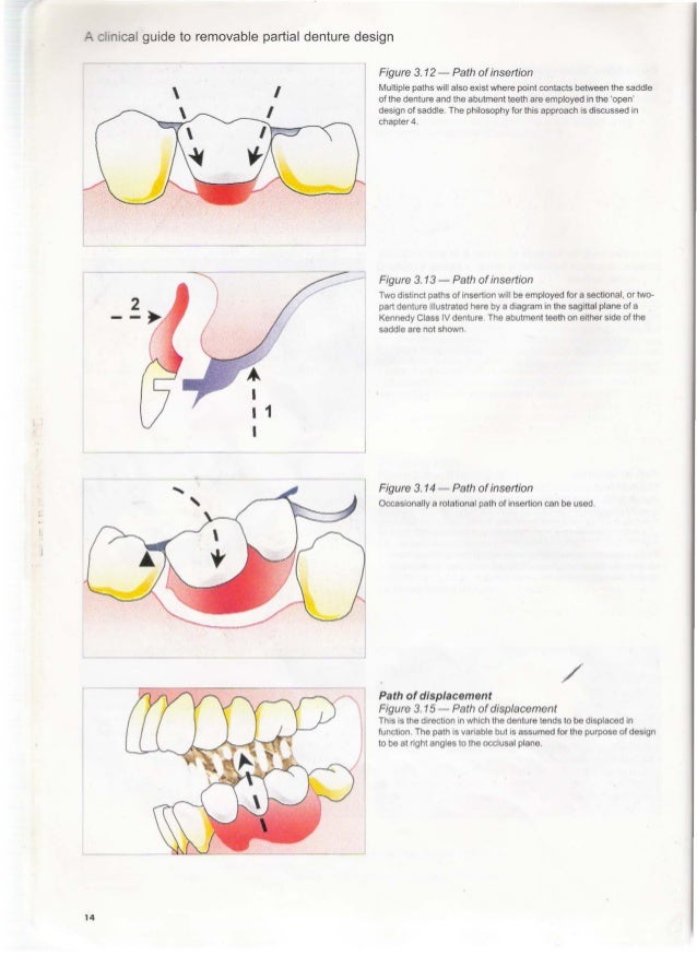 removable partial denture design