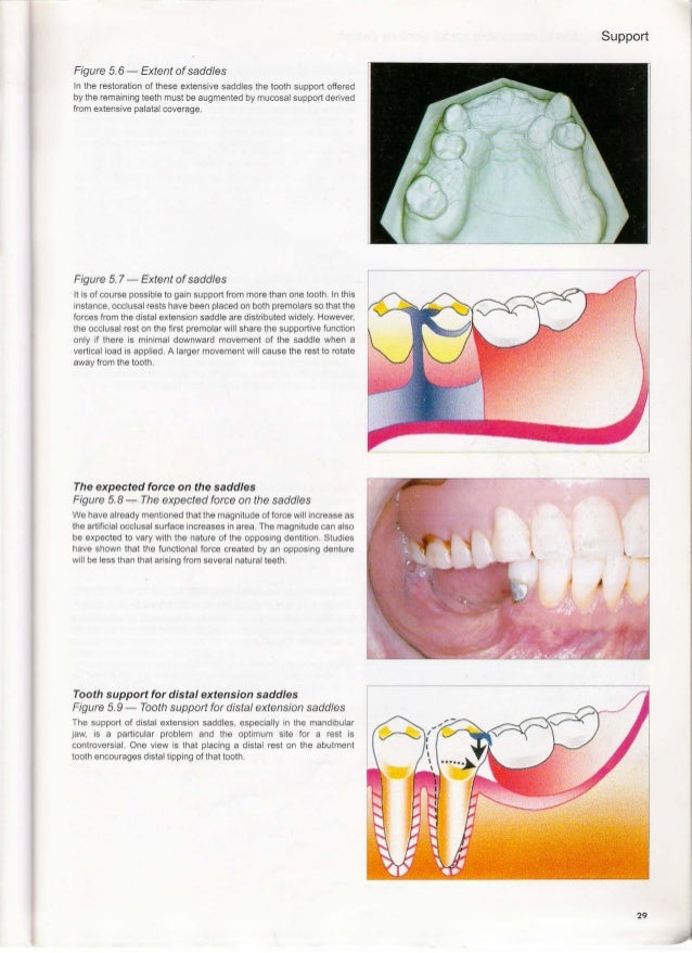 A clinical guide_to_removable_partial_denture_design
