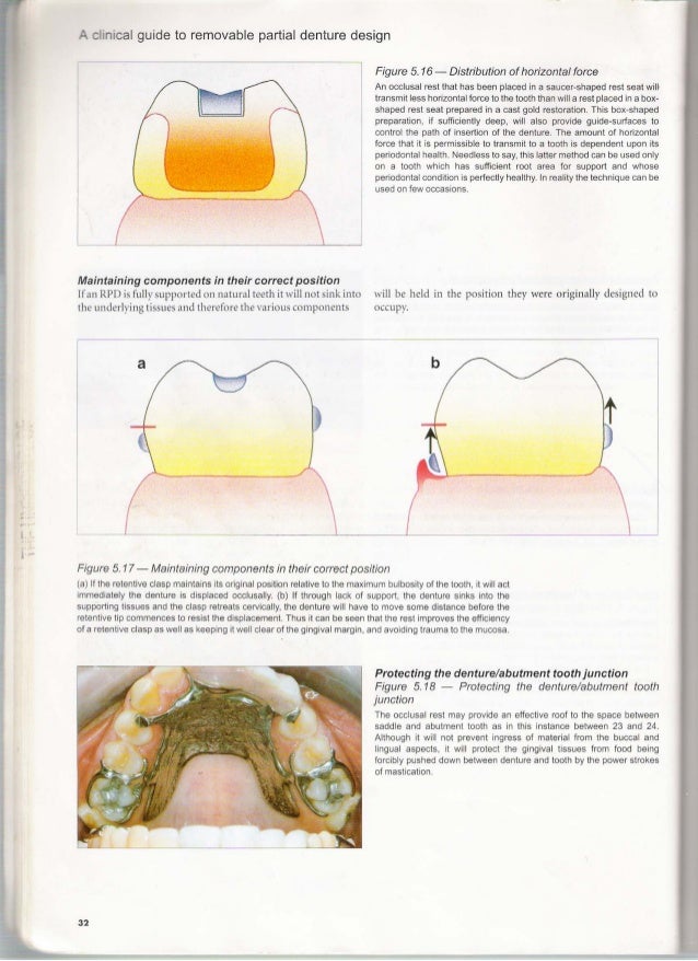 A clinical guide_to_removable_partial_denture_design