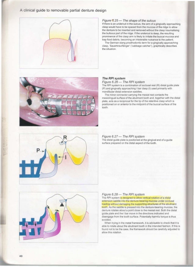 Clinical guide to removable partial dentures Telegraph
