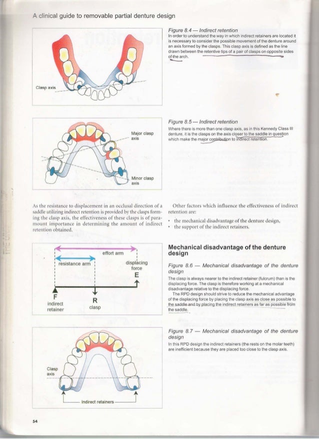 removable partial denture design