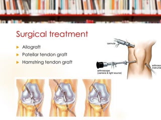 Surgical treatment
 Allograft
 Patellar tendon graft
 Hamstring tendon graft
 