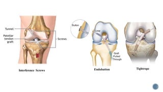 Interference Screws
TightropeEndobutton
 