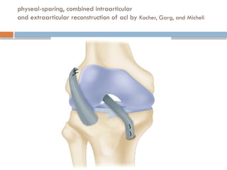 physeal-sparing, combined intraarticular
and extraarticular reconstruction of acl by Kocher, Garg, and Micheli
 
