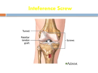 Inteference Screw
 