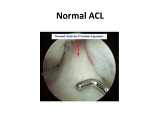 ACL injury Dr Wakil sirasaaaaaaasaaaaaa.pptx