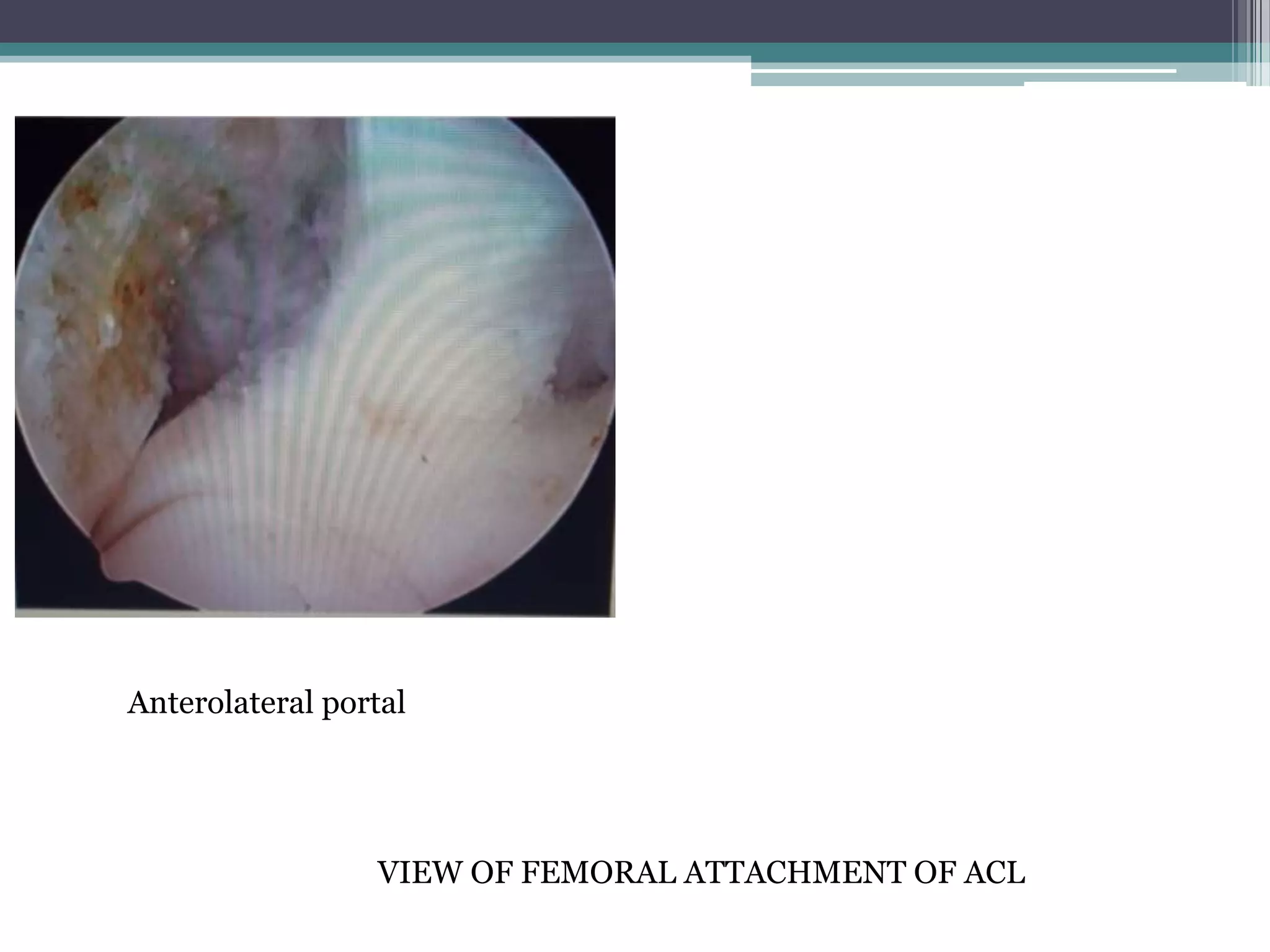 ACL reconstruction quadrapled hamstring graft PPT