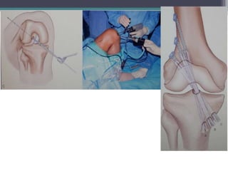 ACL reconstruction quadrapled hamstring graft | PPTX
