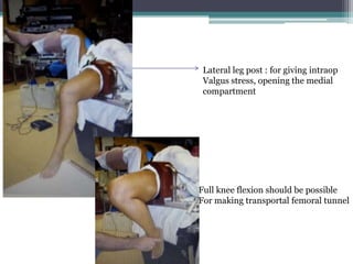 ACL reconstruction quadrapled hamstring graft | PPTX