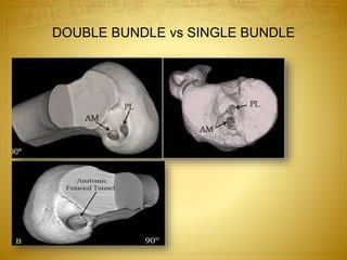 DOUBLE BUNDLE vs SINGLE BUNDLE
 