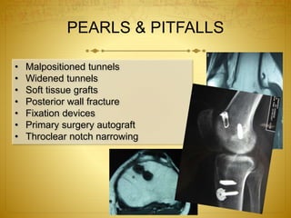 PEARLS & PITFALLS
• Malpositioned tunnels
• Widened tunnels
• Soft tissue grafts
• Posterior wall fracture
• Fixation devices
• Primary surgery autograft
• Throclear notch narrowing
 