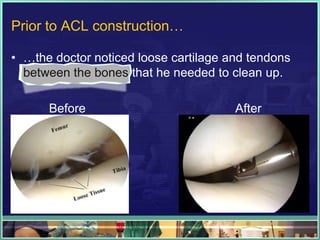 My ACL Reconstruction | PPTX