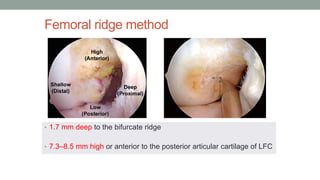 Acl reconstruction | PPTX