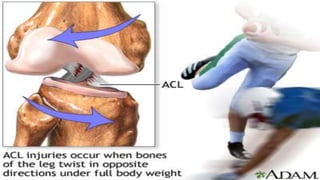 Acl reconstruction | PPTX