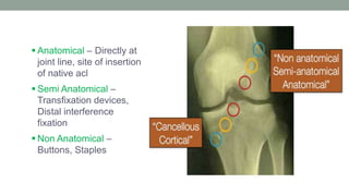 Acl reconstruction | PPTX