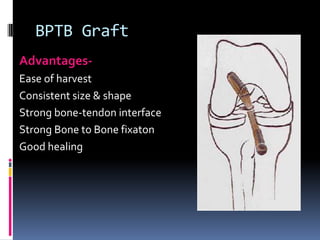 BPTB Graft
AdvantagesEase of harvest
Consistent size & shape
Strong bone-tendon interface
Strong Bone to Bone fixaton
Good healing

 