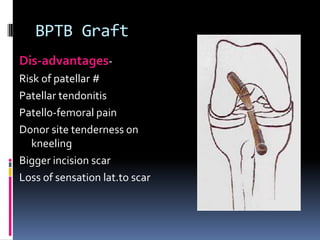 BPTB Graft
Dis-advantagesRisk of patellar #
Patellar tendonitis
Patello-femoral pain
Donor site tenderness on
kneeling
Bigger incision scar
Loss of sensation lat.to scar

 