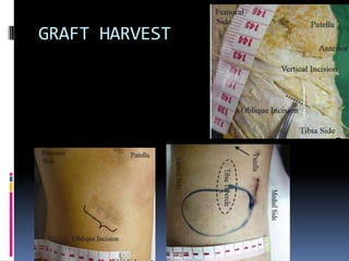 GRAFT HARVEST

 