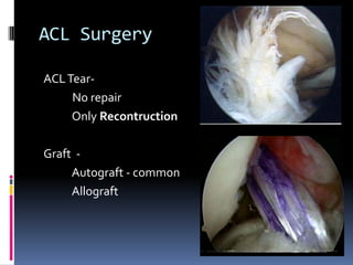 ACL Surgery
ACL TearNo repair
Only Recontruction
Graft Autograft - common
Allograft

 