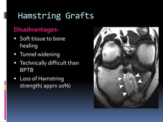Hamstring Grafts
Disadvantages Soft tissue to bone

healing
 Tunnel widening
 Technically difficult than
BPTB
 Loss of Hamstring
strength( apprx 10%)

 