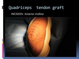 Quadriceps

tendon graft

INCISION: Anterior midline

 