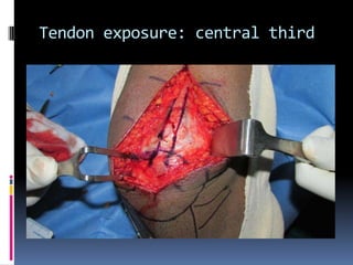 Tendon exposure: central third

 