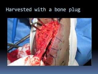 Harvested with a bone plug

 