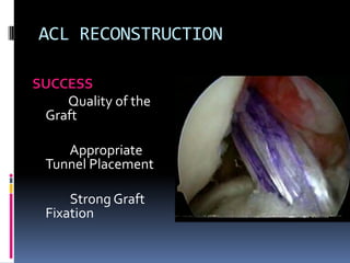 ACL RECONSTRUCTION
SUCCESS
Quality of the
Graft
Appropriate
Tunnel Placement
Strong Graft
Fixation

 