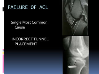 FAILURE OF ACL
Single Most Common
Cause
INCORRECT TUNNEL
PLACEMENT

 