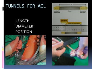 TUNNELS FOR ACL
LENGTH
DIAMETER
POSITION

 