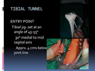 TIBIAL TUNNEL
ENTRY POINT
Tibial jig- set at an
angle of 45-550
300 medial to mid
sagital axis
Apprx. 4 cms below
joint line

 