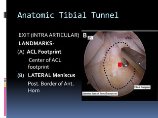 Anatomic Tibial Tunnel
EXIT (INTRA ARTICULAR)
LANDMARKS(A) ACL Footprint
Center of ACL
footprint
(B) LATERAL Meniscus
Post. Border of Ant.
Horn

 