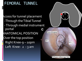 FEMORAL TUNNEL
12

Access for tunnel placement
-Through the Tibial Tunnel
- Through medial instrument
portal
ANATOMICAL POSITION
-Over the top position
- Right Knee-9 10pm
- Left Knee- 2 - 3 am

3

9
6

 