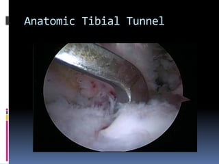 Anatomic Tibial Tunnel

 