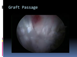 Graft Passage

 