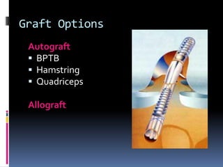 Graft Options
Autograft
 BPTB
 Hamstring
 Quadriceps
Allograft

 
