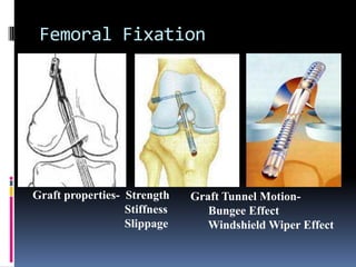 Femoral Fixation

Graft properties- Strength
Stiffness
Slippage

Graft Tunnel MotionBungee Effect
Windshield Wiper Effect

 