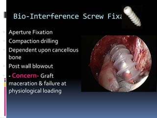 Bio-Interference Screw Fixation
 Aperture Fixation

 Compaction drilling
 Dependent upon cancellous
bone
 Post wall blowout
 - Concern- Graft
maceration & failure at
physiological loading

 