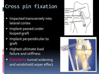 Cross pin fixation
 Impacted transversely into
lateral cortex
 Implant passed under
looped graft
 Implant perpendicular to

graft
 Highest ultimate load
failure and stiffness

 Concern- tunnel widening
and windshield wiper effect

 