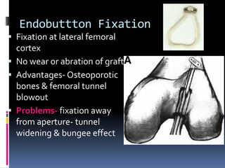 Endobuttton Fixation
 Fixation at lateral femoral

cortex
 No wear or abration of graft
 Advantages- Osteoporotic
bones & femoral tunnel
blowout
 Problems- fixation away
from aperture- tunnel
widening & bungee effect

 