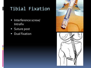 Tibial Fixation
 Interference screw/

Intrafix
 Suture post
 Dual fixation

 