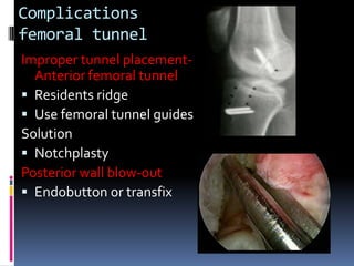 Complications
femoral tunnel
Improper tunnel placementAnterior femoral tunnel
 Residents ridge
 Use femoral tunnel guides
Solution
 Notchplasty
Posterior wall blow-out
 Endobutton or transfix

 