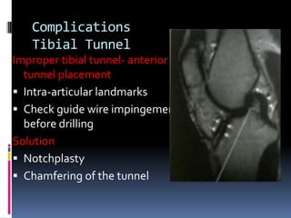 Complications
Tibial Tunnel
Improper tibial tunnel- anterior
tunnel placement
 Intra-articular landmarks
 Check guide wire impingement
before drilling
Solution
 Notchplasty
 Chamfering of the tunnel

 