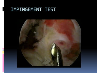 IMPINGEMENT TEST

 