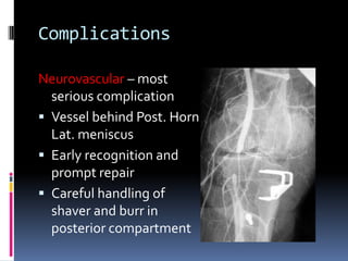 Complications
Neurovascular most
serious complication
 Vessel behind Post. Horn
Lat. meniscus
 Early recognition and
prompt repair
 Careful handling of
shaver and burr in
posterior compartment

 