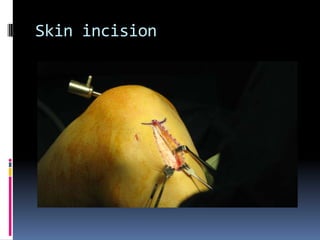 Skin incision

 